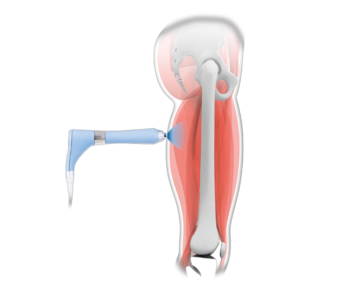 Extrakorporale radiale Stosswellentherapie